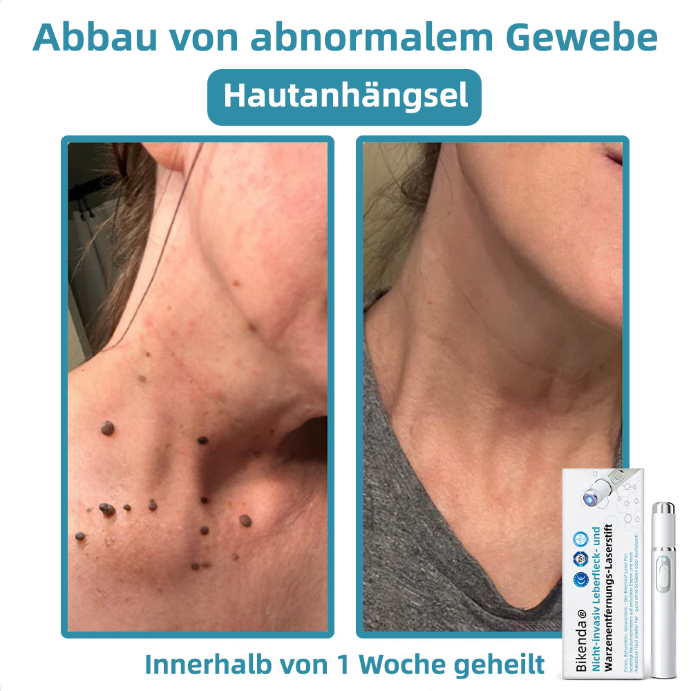 𝐁i𝐤e𝐧da® N𝐢ch𝐭-i𝐧va𝐬iv 𝐋𝐞b𝐞rfl𝐞ck- 𝐮𝐧𝐝 𝐖𝐚rz𝐞n𝐞n𝐭f𝐞r𝐧𝐮𝐧g𝐬-La𝐬𝐞r𝐬tift 𝐏𝐫o𝐦ox🚁